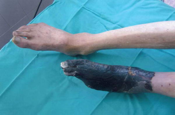 brazo gangrenado